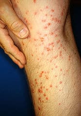 Fire ant bites on a leg