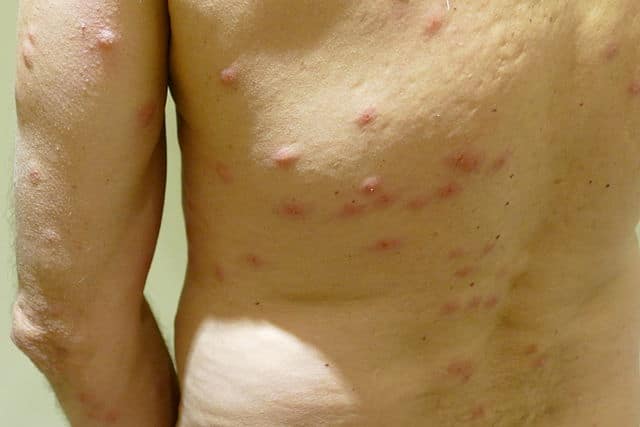 Bedbug bites on man's back
