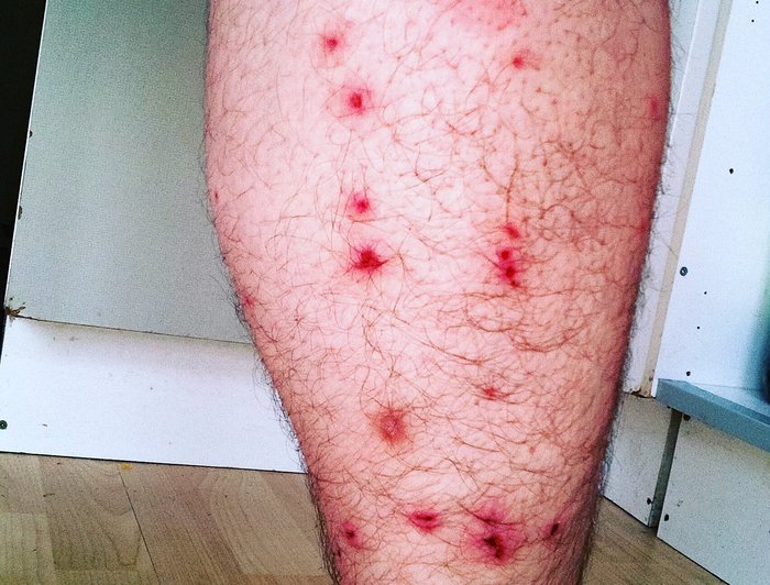 Bed bug bites on a leg.