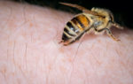 bee sting