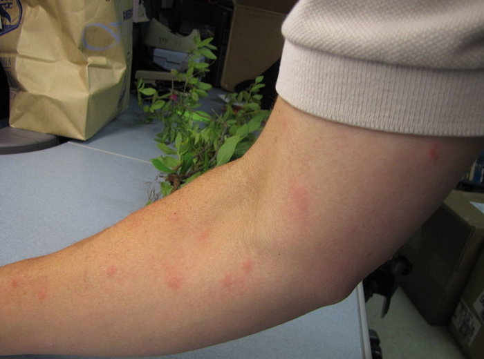 Mosquito bites on an arm. 