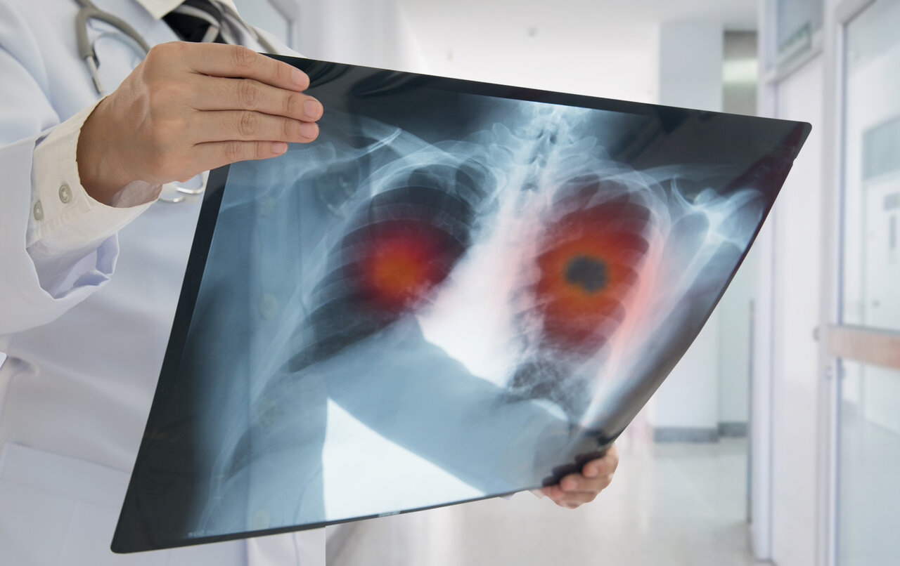 X-ray showing lung cancer