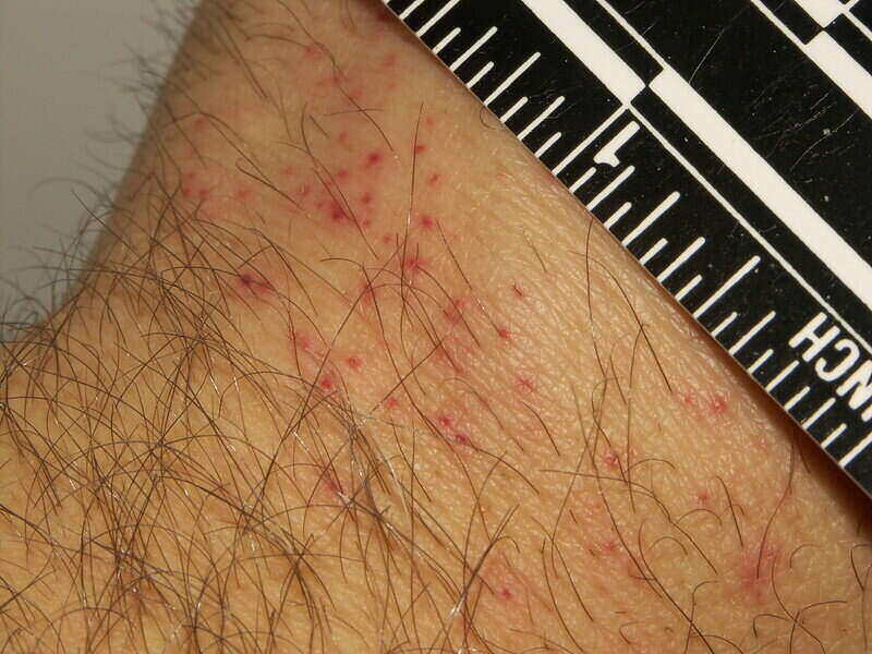 close-up of bed bug bites on a hand