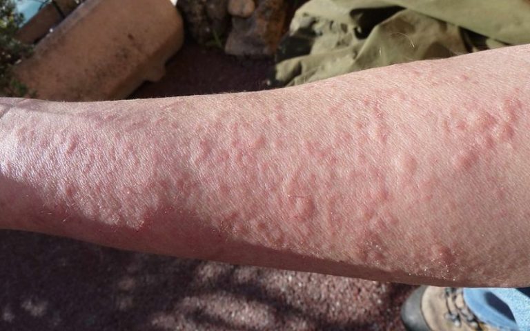 Arm Rash - Someplants cause rashes. 