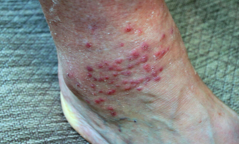 Chigger bites