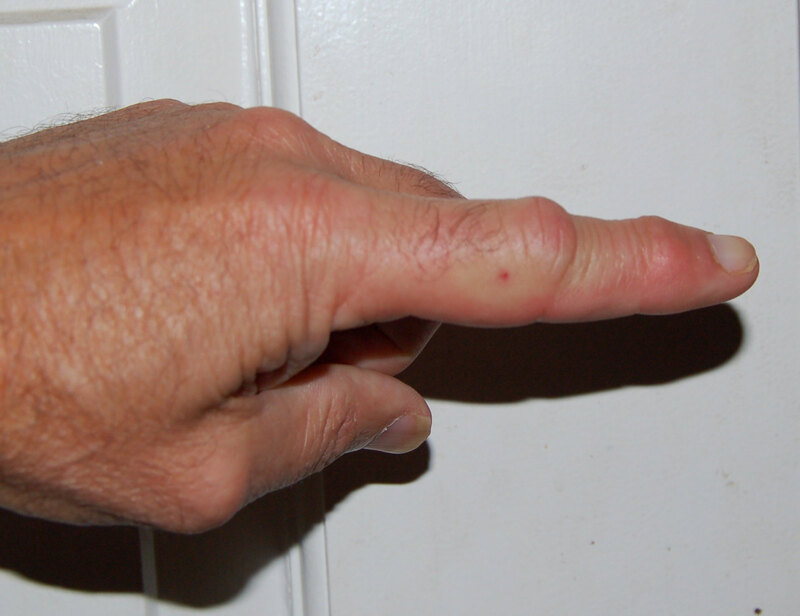 wasp sting