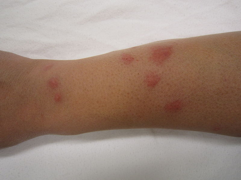 bed bug bite