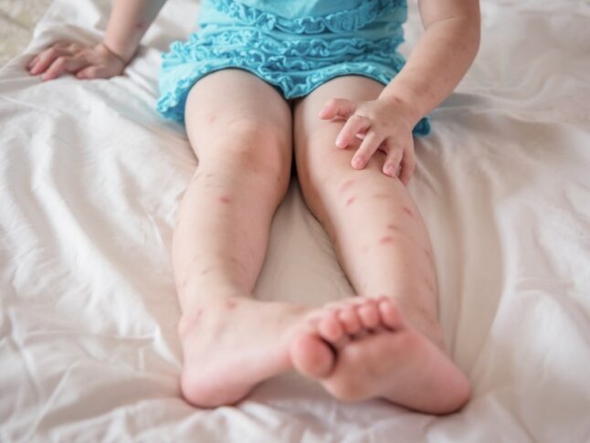 young child with mosquito bites on their legs