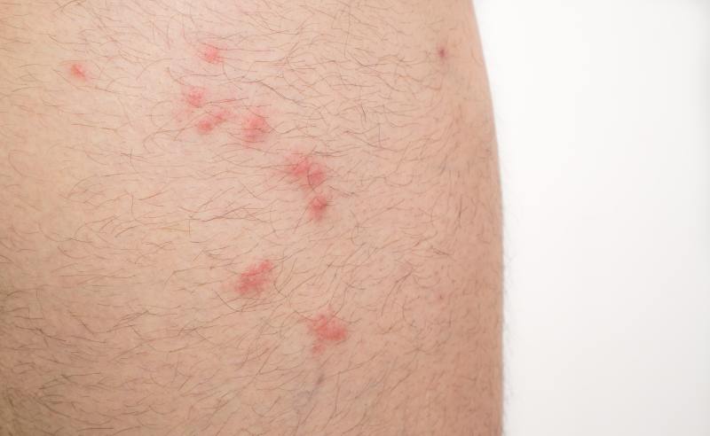 Close up view of flea bites on caucasian man leg skin